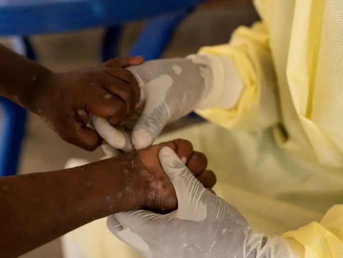 Sa&uacute;de negocia compra de 25 mil doses de vacina contra mpox