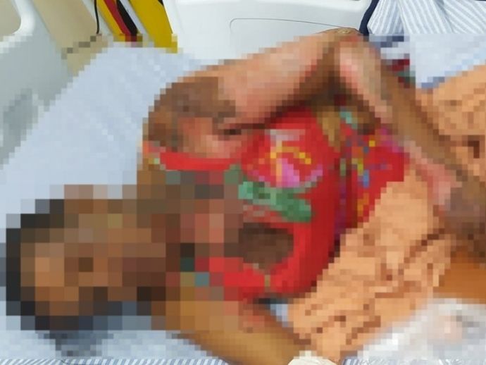 Mulher que teve 70% do corpo queimado pelo companheiro morre no HGE