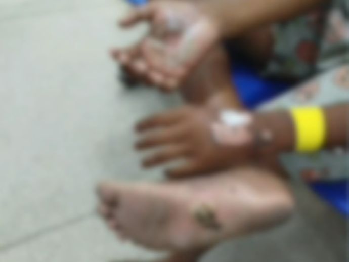 Menino de 10 anos sofre queimaduras graves e acusa a m&atilde;e de agress&atilde;o em Jaboat&atilde;o