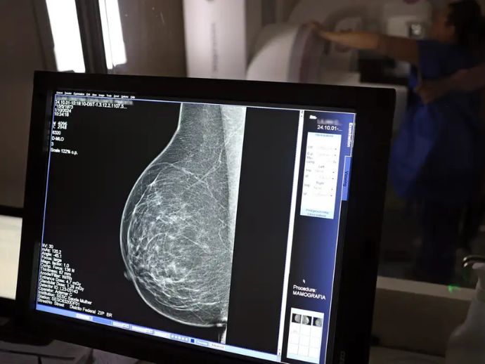Minist&eacute;rio da Sa&uacute;de passa a recomendar mamografia a partir dos 40 anos