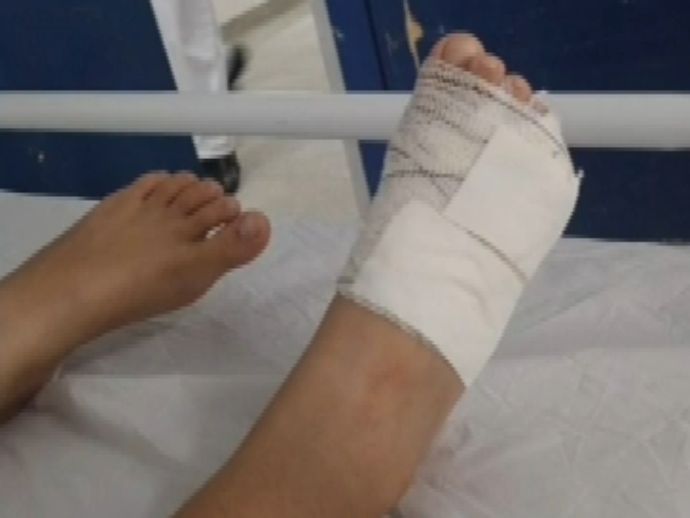 Crian&ccedil;a de 8 anos tem dedo amputado ap&oacute;s acidente em brinquedo de pra&ccedil;a no Ibura