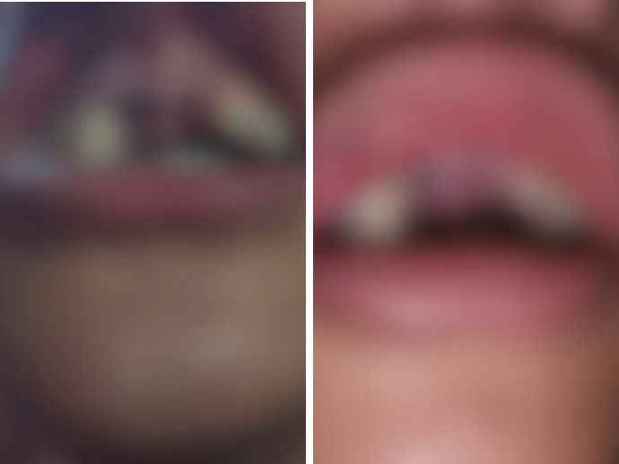 Adolescente perde dentes em agress&atilde;o com o irm&atilde;o de 18 anos