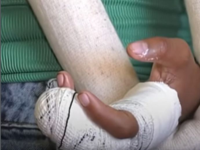 Crian&ccedil;a perde parte do dedo ap&oacute;s ataque de cadela solta em Olinda