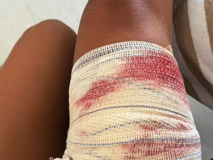Turista de S&atilde;o Paulo &eacute; mordida por tubar&atilde;o em Fernando de Noronha