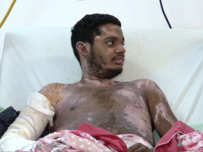 Cerca de 21 pessoas sofreram queimaduras com fogos ou fogueiras neste S&atilde;o Jo&atilde;o, segundo HR