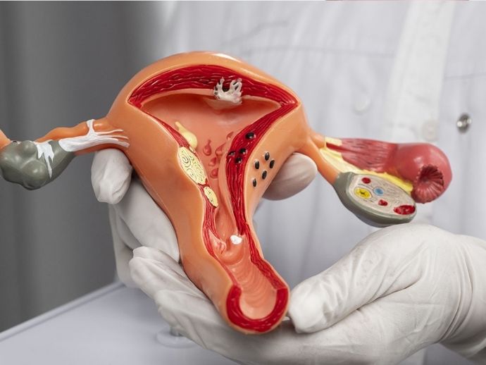 CNPq abre chamamento p&uacute;blico para pesquisas sobre endometriose