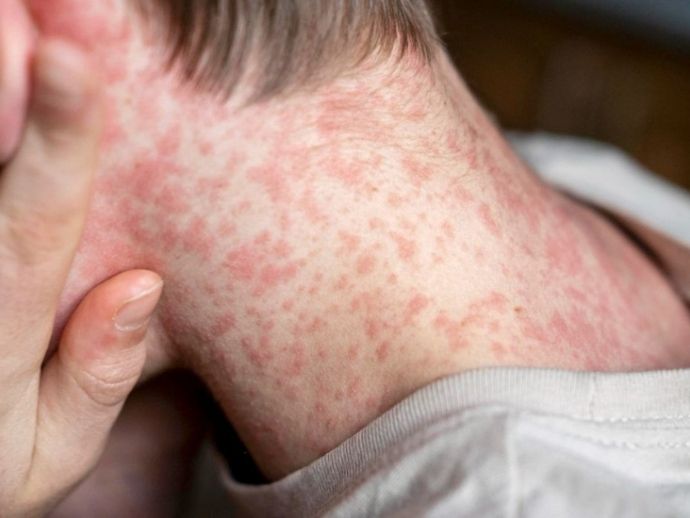 Casos de sarampo aumentam e refor&ccedil;am alerta sobre vacina&ccedil;&atilde;o no Brasil