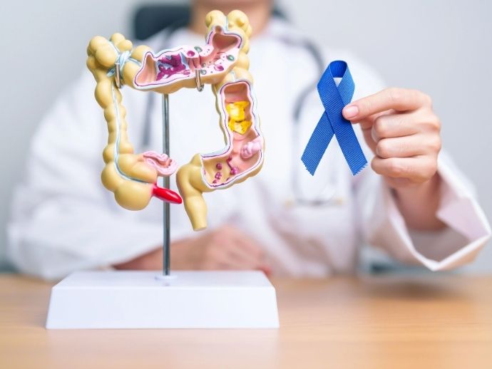 Minist&eacute;rio da Sa&uacute;de anuncia novo exame para identificar c&acirc;ncer de intestino