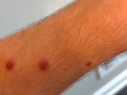 Prefeitura do Paulista refor&ccedil;a medidas de sa&uacute;de ap&oacute;s surto de catapora