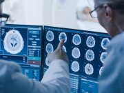 AVC é uma das principais causas de morte no Brasil, registrando mais de 100 mil óbitos por ano