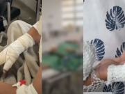 Cresce o n&uacute;mero de crian&ccedil;as feridas no setor de queimados do Hospital da Restaura&ccedil;&atilde;o