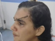 Mulher &eacute; atingida por prego na testa em posto de sa&uacute;de no Ibura