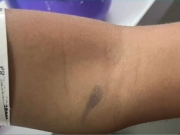 Madrasta &eacute; suspeita de espancar e queimar menina de 4 anos em Olinda