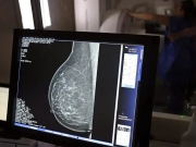 Minist&eacute;rio da Sa&uacute;de passa a recomendar mamografia a partir dos 40 anos