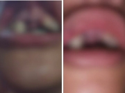 Adolescente perde dentes em agressão com o irmão de 18 anos