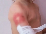 Pernambuco ocupa o 4&ordm; lugar em interna&ccedil;&otilde;es de crian&ccedil;as no pa&iacute;s por queimaduras