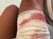 Turista de S&atilde;o Paulo &eacute; mordida por tubar&atilde;o em Fernando de Noronha