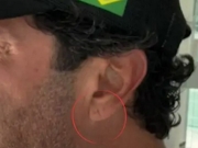 Sinal de Frank: dobra na orelha pode indicar risco de infarto e AVC