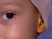 Procedimento que corrige "orelhas de abano" muda vida de garoto de 6 anos