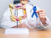 Ministério da Saúde anuncia novo exame para identificar câncer de intestino